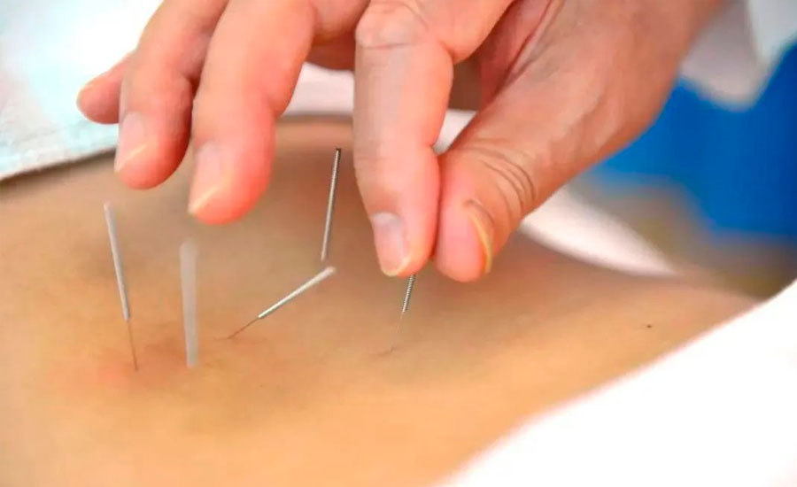 Tourist Acupuncture and Moxibustion Experience