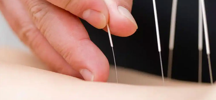 Acupuncture and Moxibustion